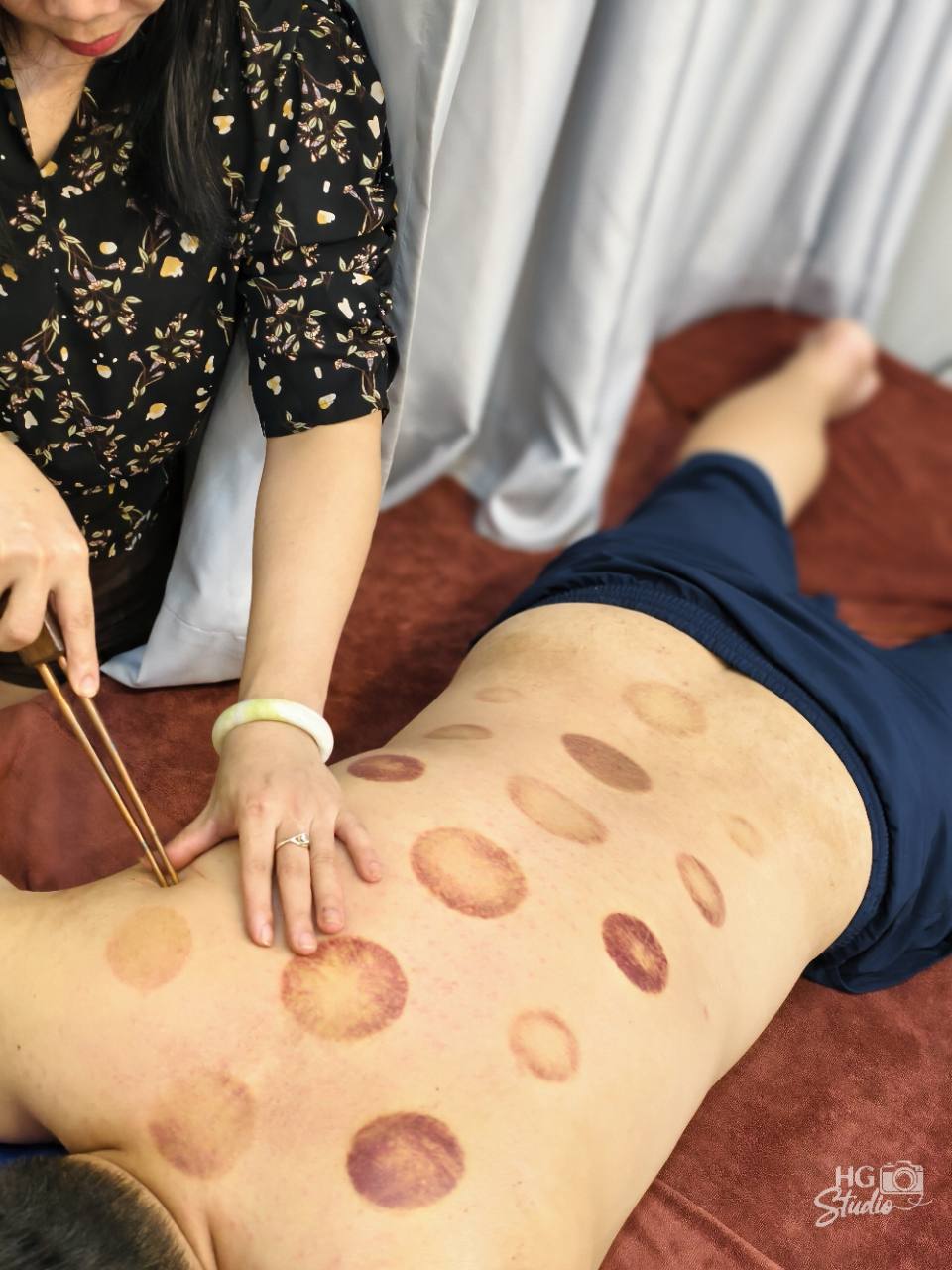 Huyền châm cứu ngải vùng lưng tại HG Mộc Bản