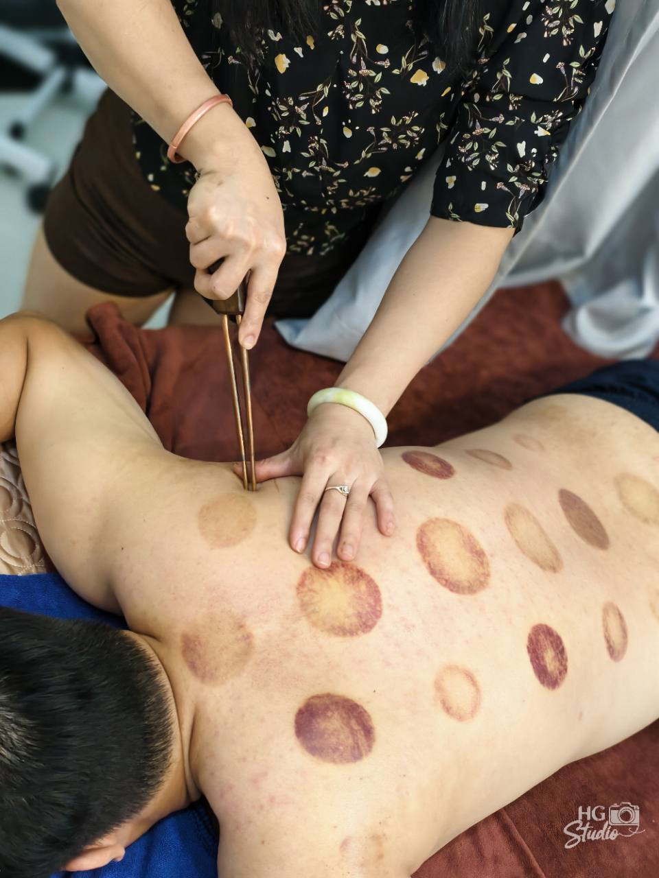 Kỹ thuật huyền châm cứu ngải tại HG Mộc Bản