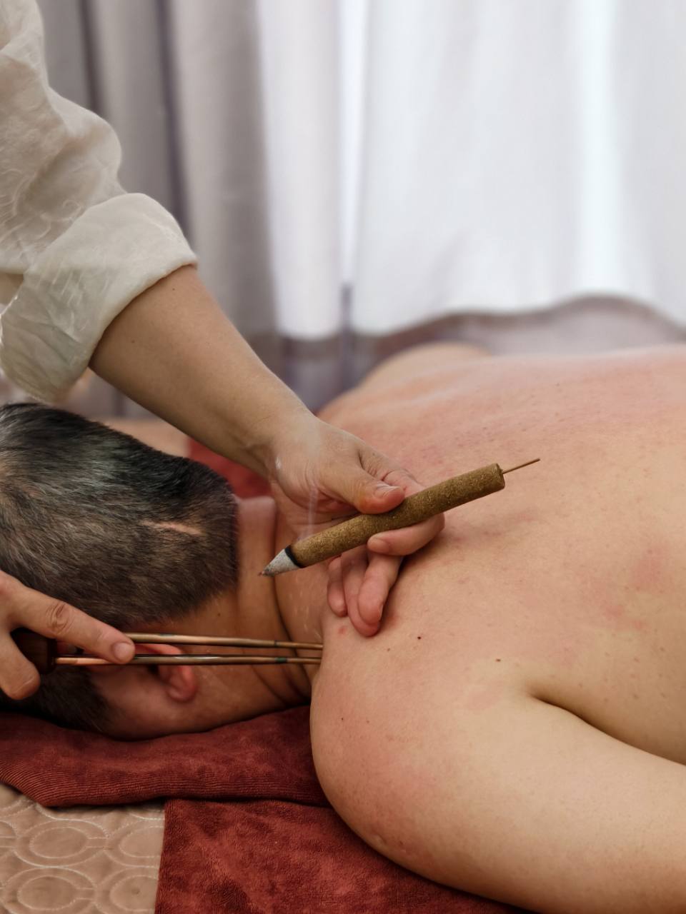 Huyền châm ngải cứu vùng cổ vai gáy tại HG Mộc Bản